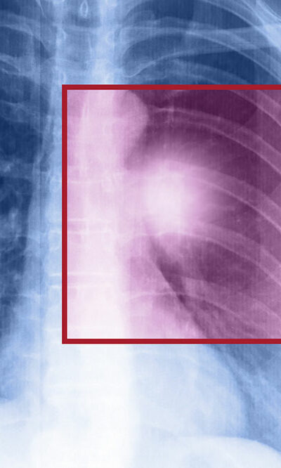 Lung cancer – Types, symptoms, and causes